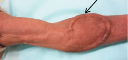 人工血管内シャントの画像