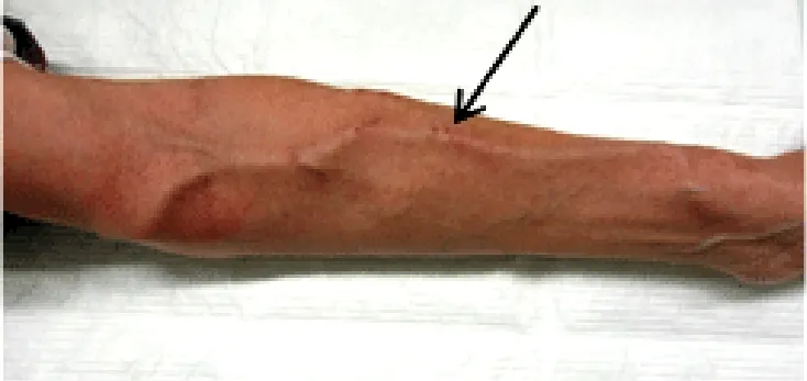 自己血管内シャントの画像