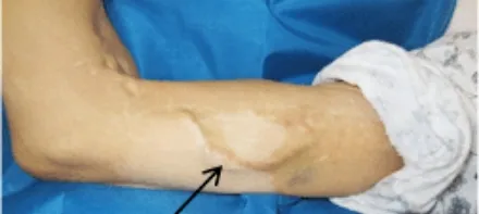 上腕動脈表在化の画像