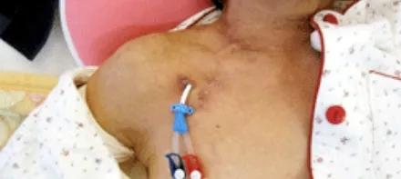 長期(カフ型)留置カテーテルの画像